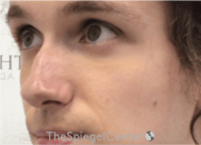 Cheek Implants Before & After Gallery - Patient 157139879 - Image 1