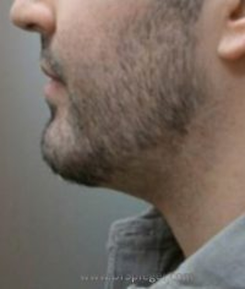 Chin Augmentation