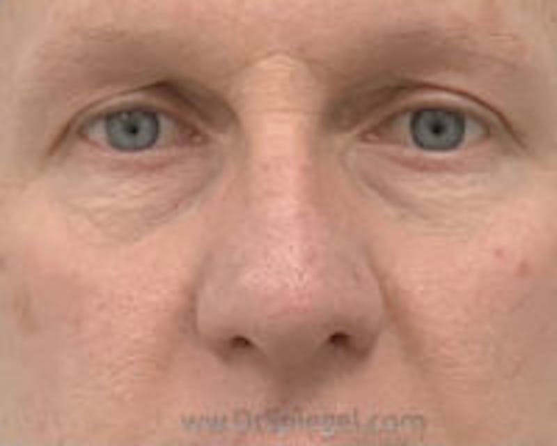 Blepharoplasty Before & After Gallery - Patient 157139881 - Image 1