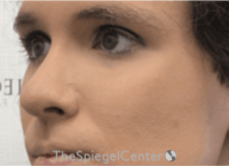 Cheek Implants Before & After Gallery - Patient 157139879 - Image 2