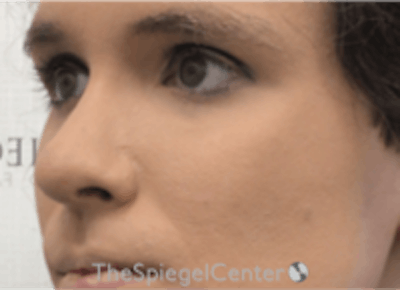 Cheek Implants Before & After Gallery - Patient 157139879 - Image 2