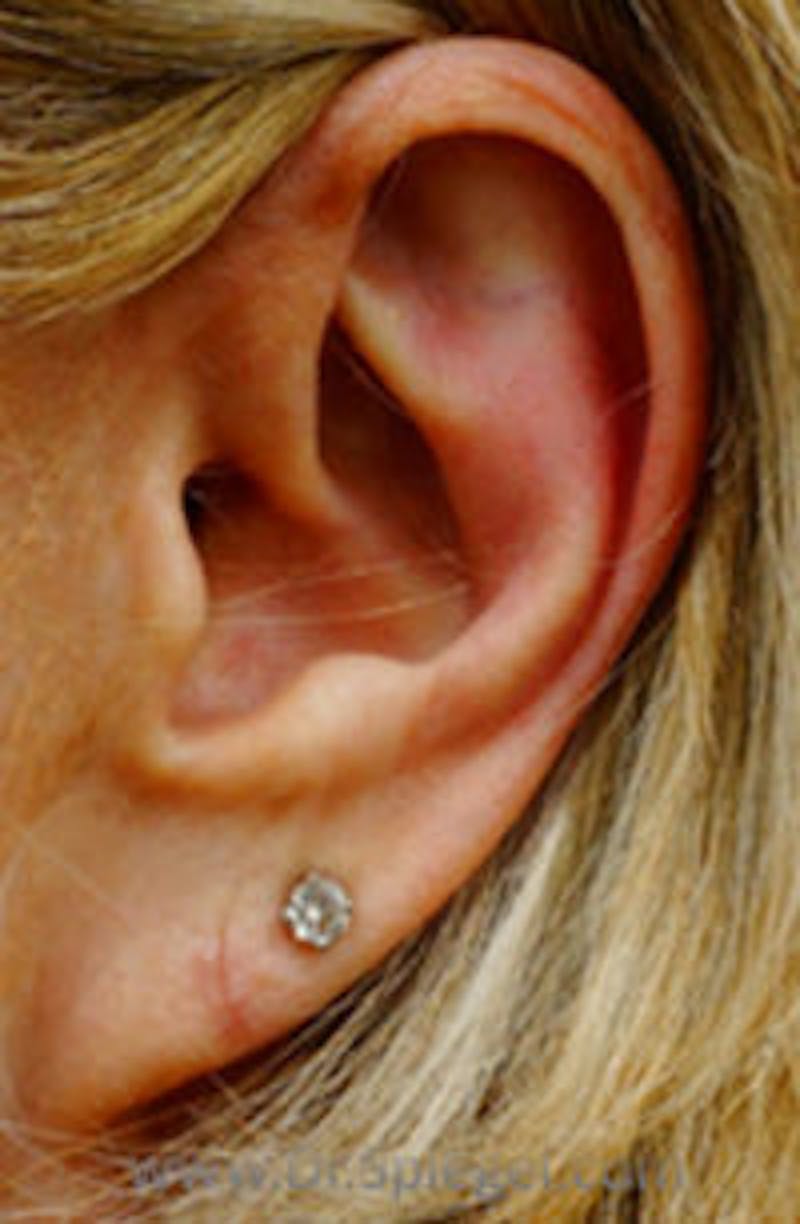 Ear Lobe Repair Before & After Gallery - Patient 157139882 - Image 2