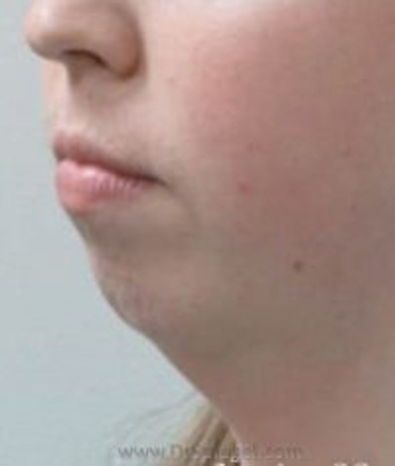 Chin Augmentation Before & After Gallery - Patient 157139884 - Image 1