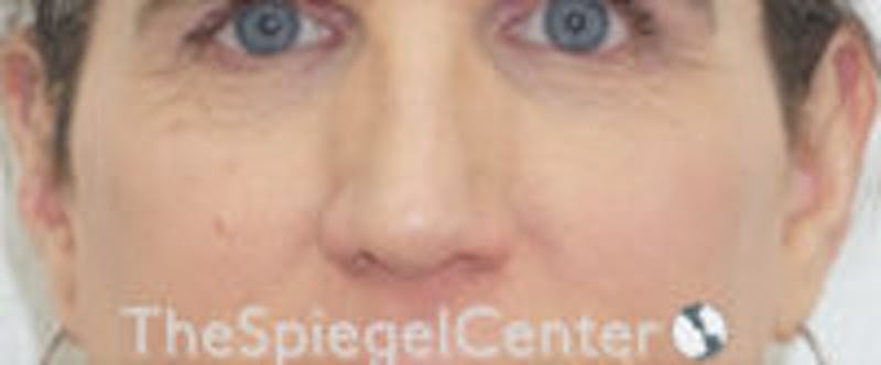 Cheek Implants Before & After Gallery - Patient 157139888 - Image 3