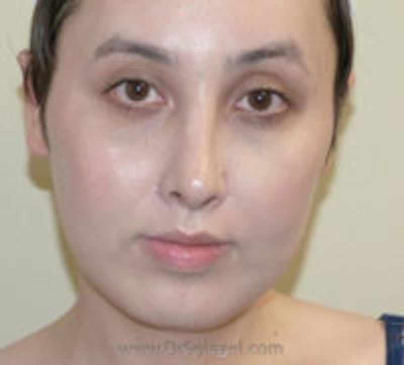 Ear Pinning / Otoplasty Before & After Gallery - Patient 157139883 - Image 2