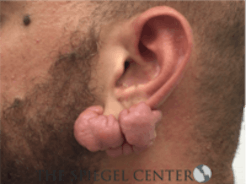 Ear Lobe Repair Before & After Gallery - Patient 157139887 - Image 1