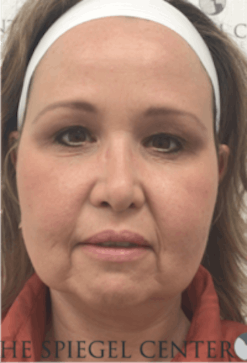 Facelift Before & After Gallery - Patient 157139900 - Image 1