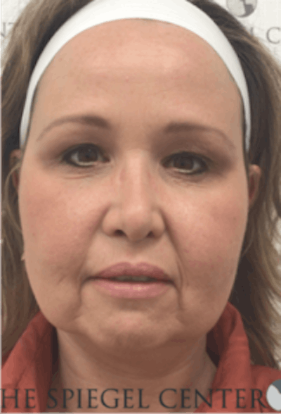 Facelift Before & After Gallery - Patient 157139900 - Image 1