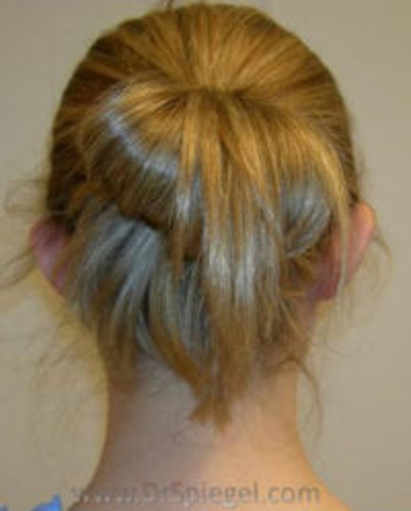 Ear Pinning / Otoplasty Before & After Gallery - Patient 157139889 - Image 1
