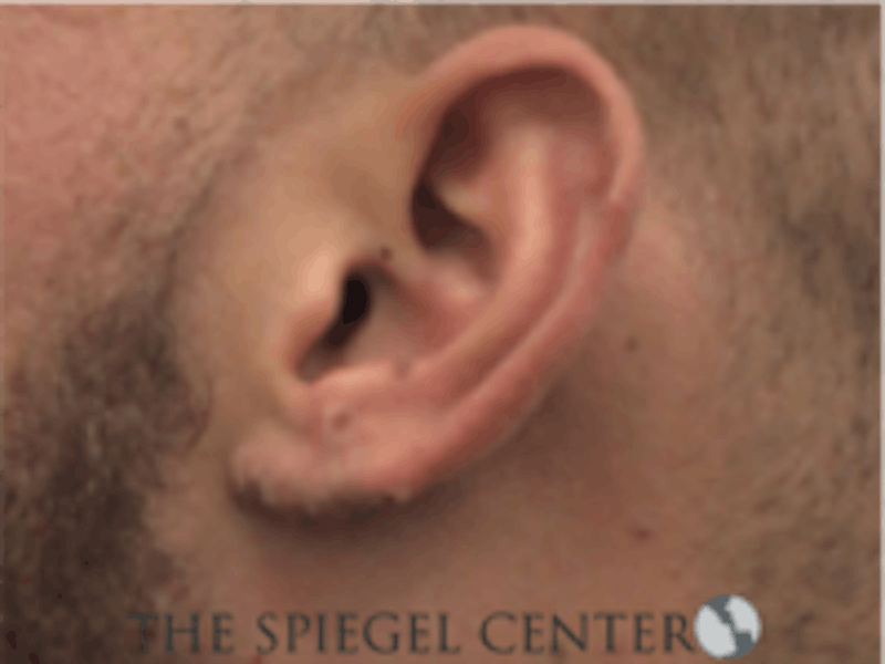 Earlobe Repair