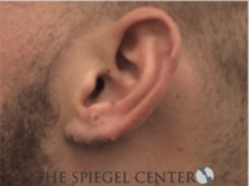 Ear Lobe Repair Before & After Gallery - Patient 157139887 - Image 2