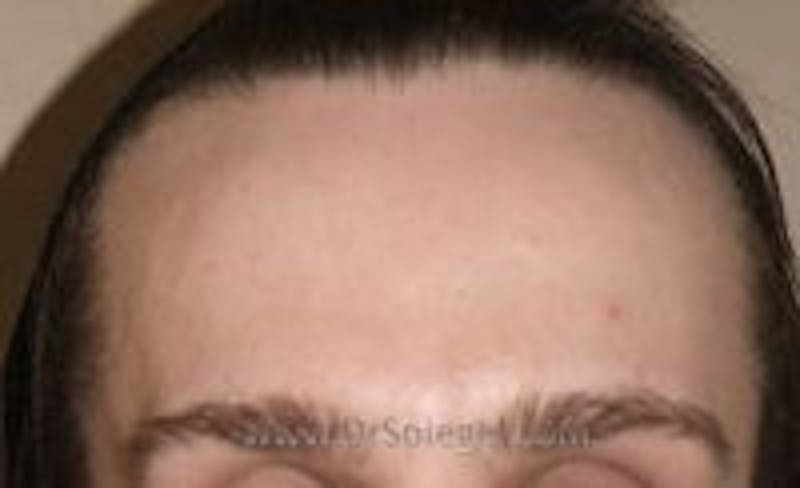 Browlift / Fox Eye Lift Before & After Gallery - Patient 157139894 - Image 1