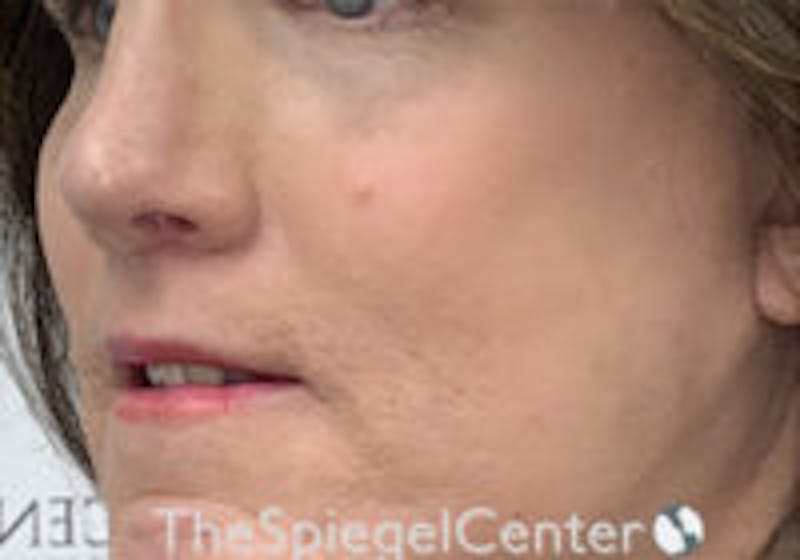 Cheek Implants Before & After Gallery - Patient 157139888 - Image 2