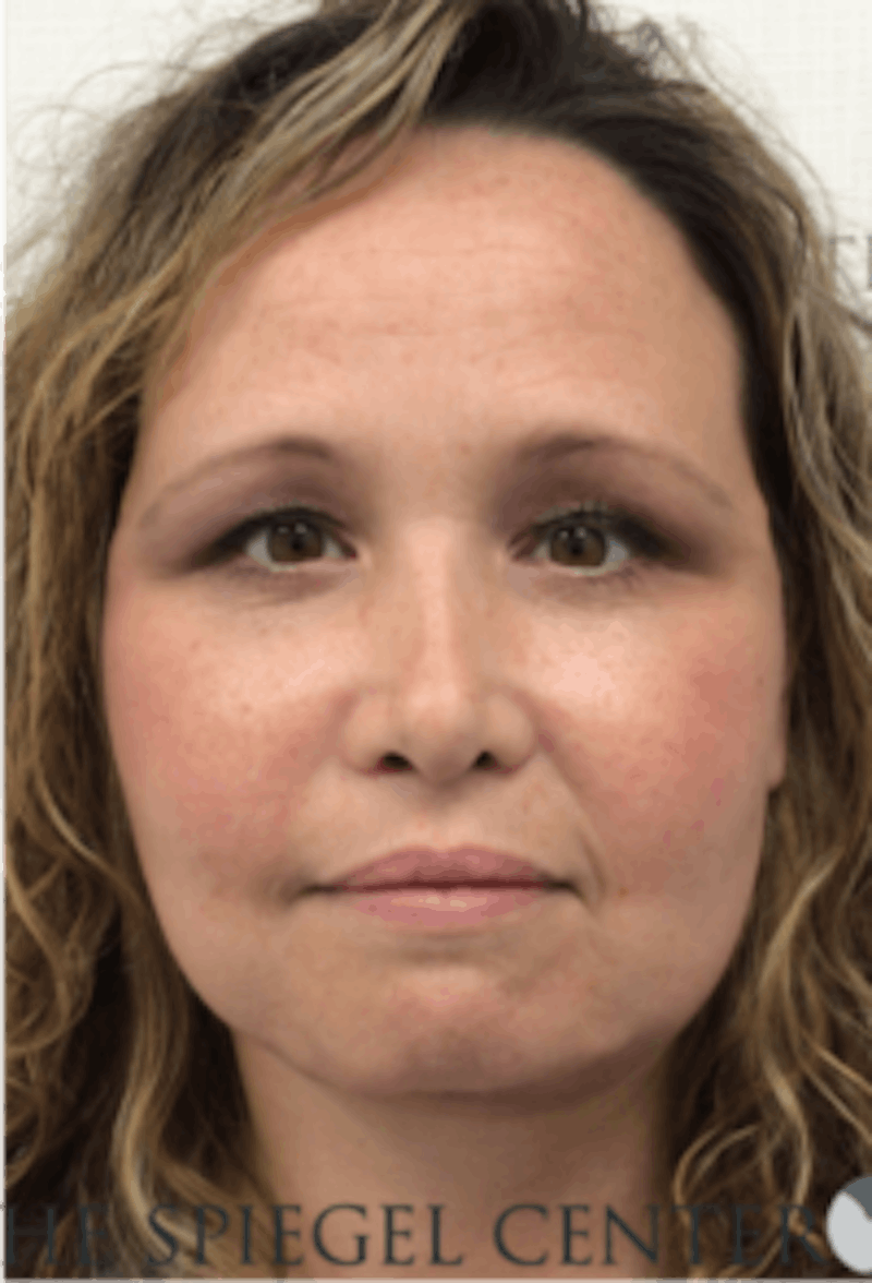 Facelift Before & After Gallery - Patient 157139900 - Image 2