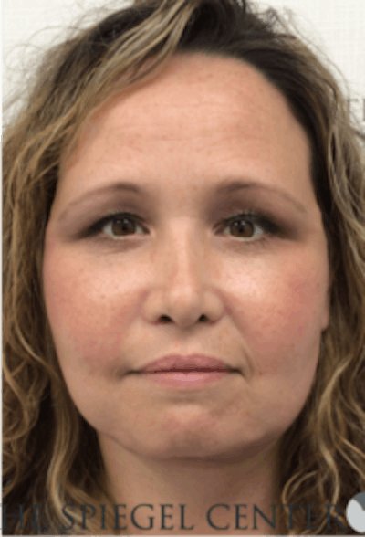 Facelift Before & After Gallery - Patient 157139900 - Image 2