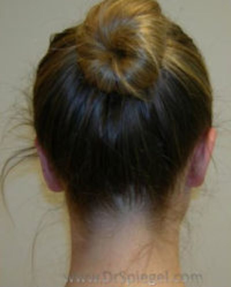 Ear Pinning / Otoplasty Before & After Gallery - Patient 157139889 - Image 2