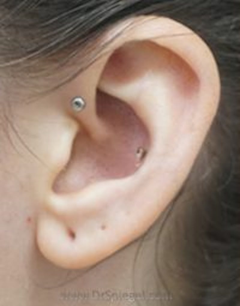 Ear Lobe Repair Before & After Gallery - Patient 157139896 - Image 1