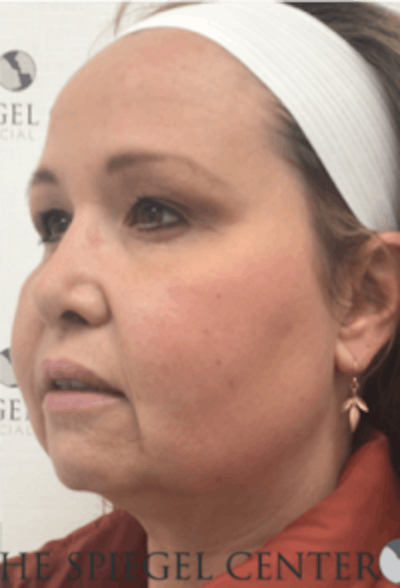 Facelift Before & After Gallery - Patient 157139900 - Image 3