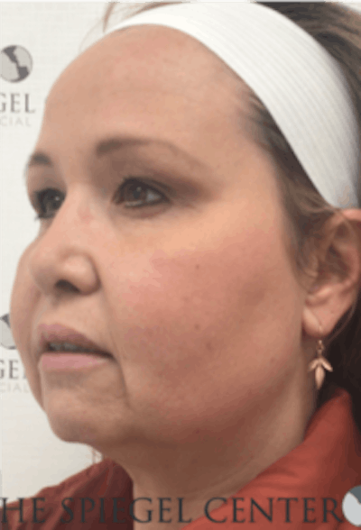 Facelift Before & After Gallery - Patient 157139900 - Image 3