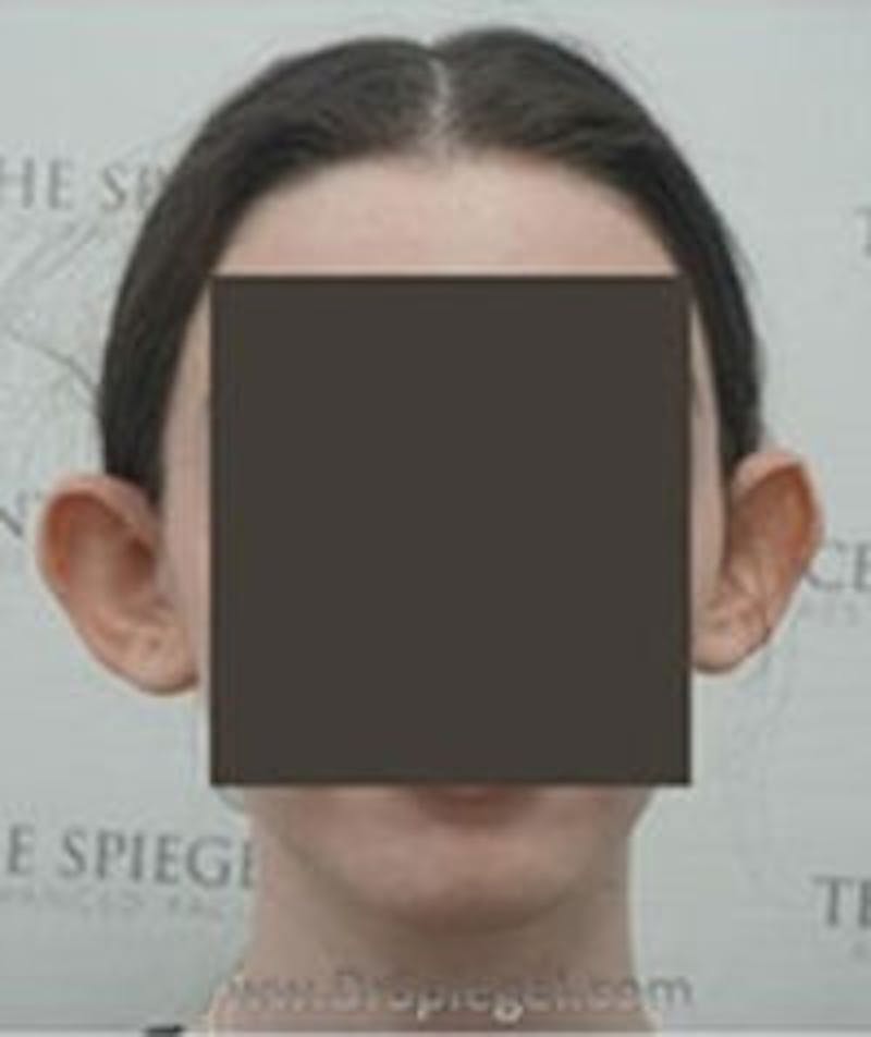 Ear Pinning / Otoplasty Before & After Gallery - Patient 157139903 - Image 1