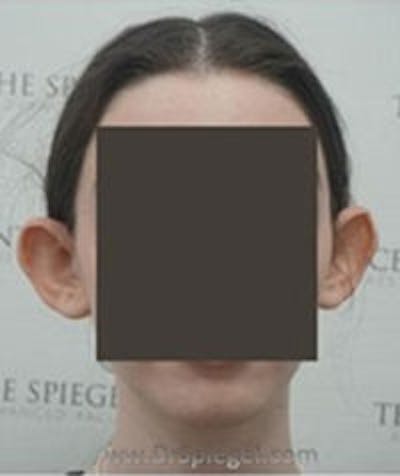 Ear Pinning / Otoplasty Before & After Gallery - Patient 157139903 - Image 1