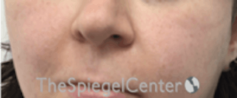 Cheek Implants Before & After Gallery - Patient 157139904 - Image 3