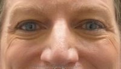 Blepharoplasty Before & After Gallery - Patient 157139899 - Image 1