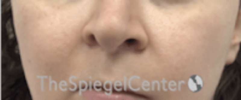 Cheek Implants Before & After Gallery - Patient 157139904 - Image 4
