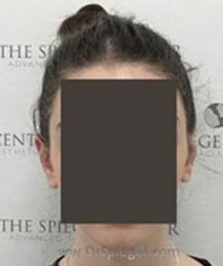 Ear Pinning / Otoplasty Before & After Gallery - Patient 157139903 - Image 2