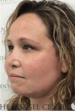 Facelift Before & After Gallery - Patient 157139900 - Image 4