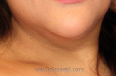 Neck Lipo Before & After Gallery - Patient 157139901 - Image 1