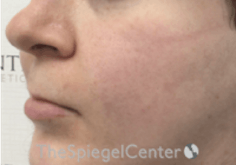 Cheek Implants Before & After Gallery - Patient 157139904 - Image 1