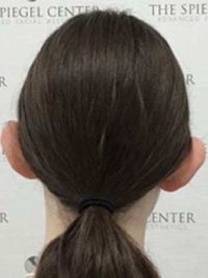 Ear Pinning / Otoplasty Before & After Gallery - Patient 157139903 - Image 3