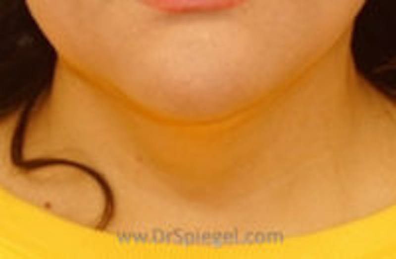 Neck Lipo Before & After Gallery - Patient 157139901 - Image 2