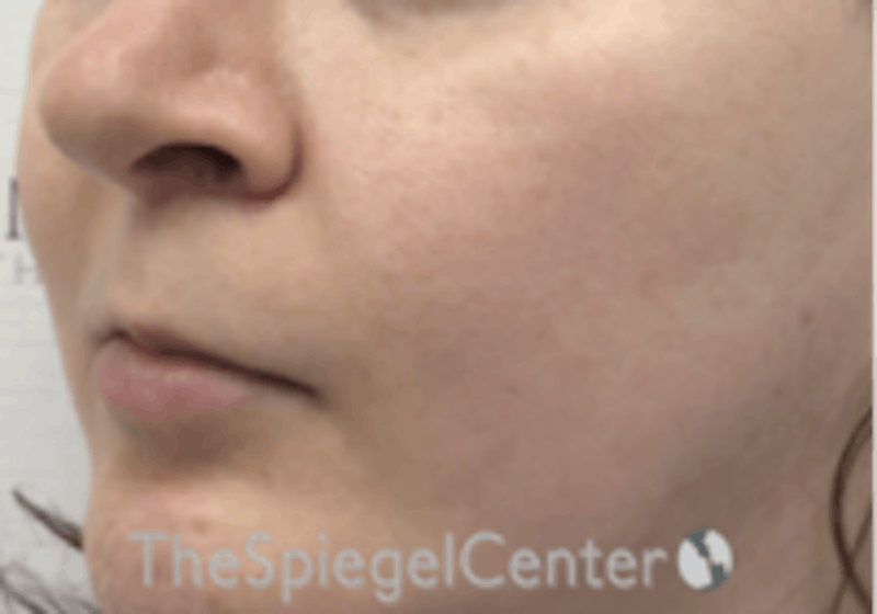 Cheek Implants Before & After Gallery - Patient 157139904 - Image 2