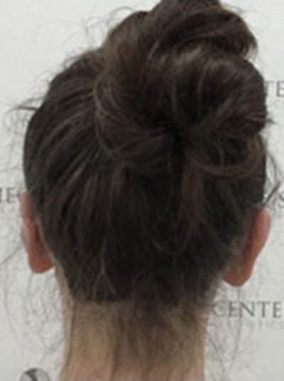 Ear Pinning / Otoplasty Before & After Gallery - Patient 157139903 - Image 4