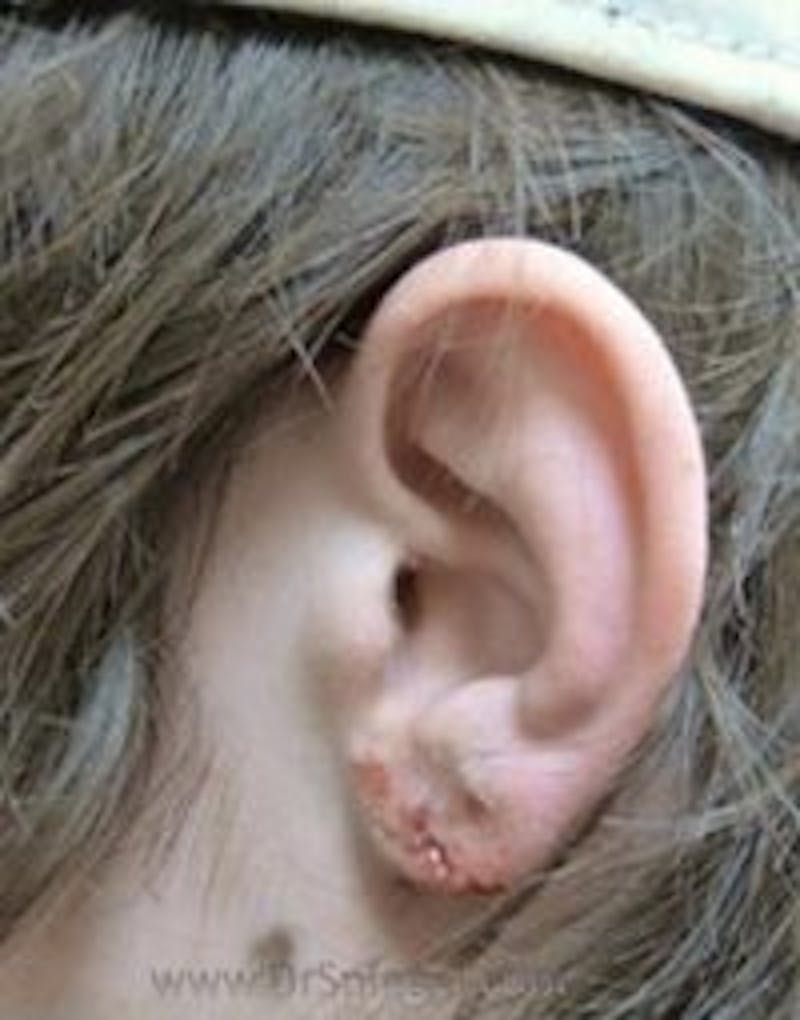 Ear Lobe Repair Before & After Gallery - Patient 157139902 - Image 2