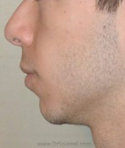Chin Augmentation Before & After Gallery - Patient 157139905 - Image 1