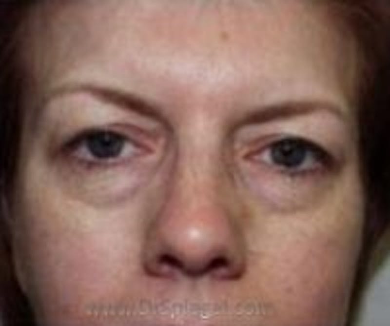 Blepharoplasty Before & After Gallery - Patient 157139907 - Image 1