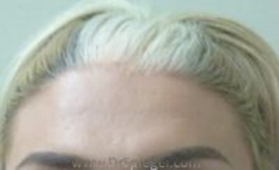 Browlift / Fox Eye Lift Before & After Gallery - Patient 157139906 - Image 1