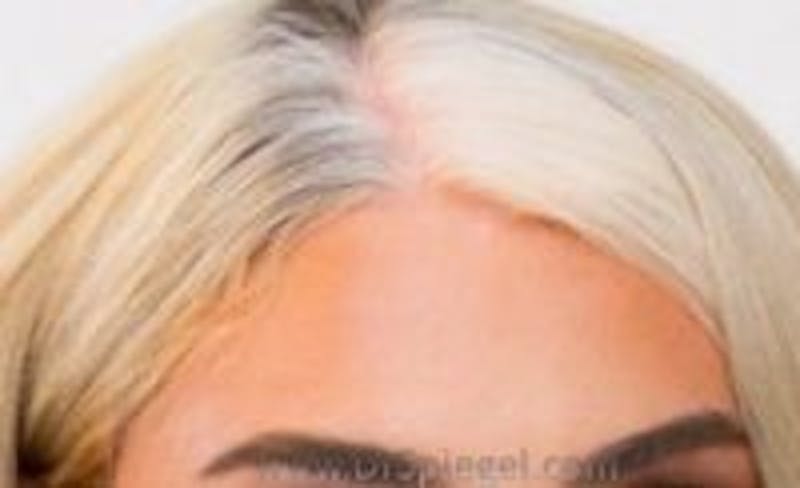 Browlift / Fox Eye Lift Before & After Gallery - Patient 157139906 - Image 2