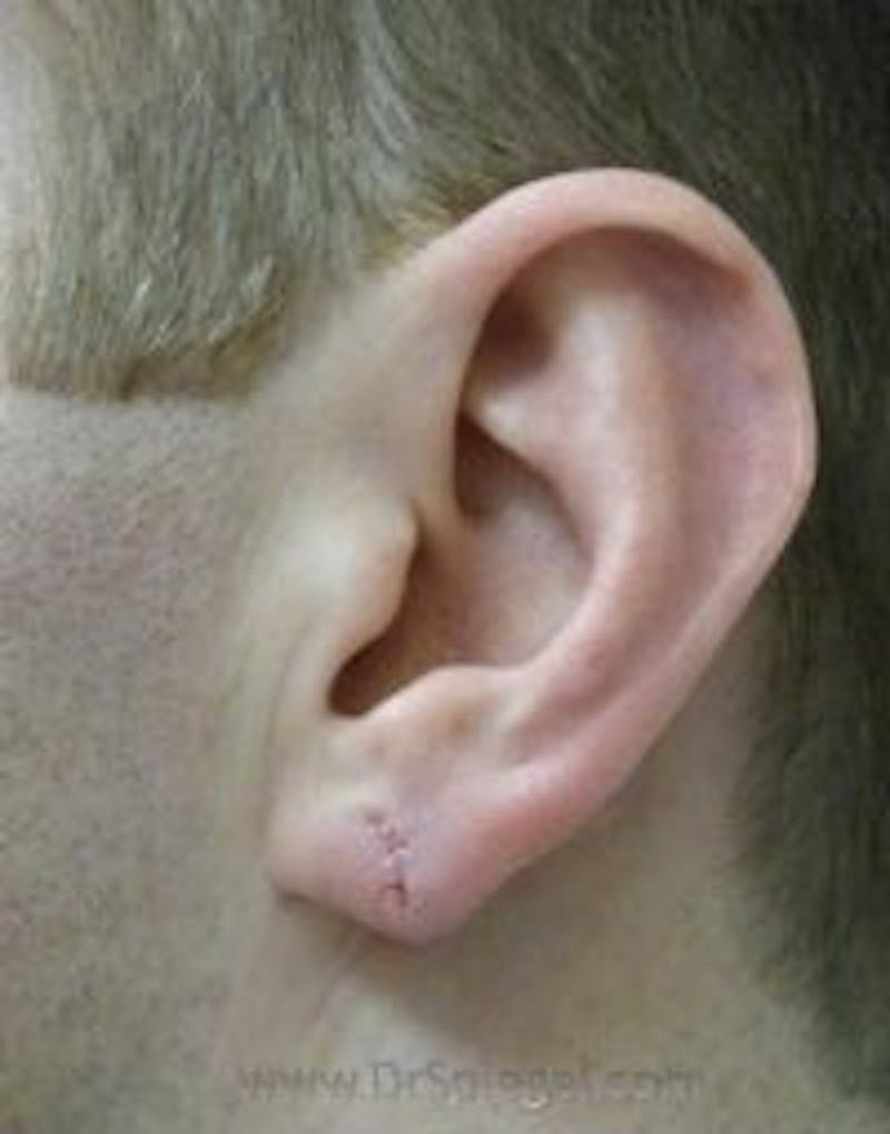 Ear Lobe Repair Before & After Gallery - Patient 157139908 - Image 2