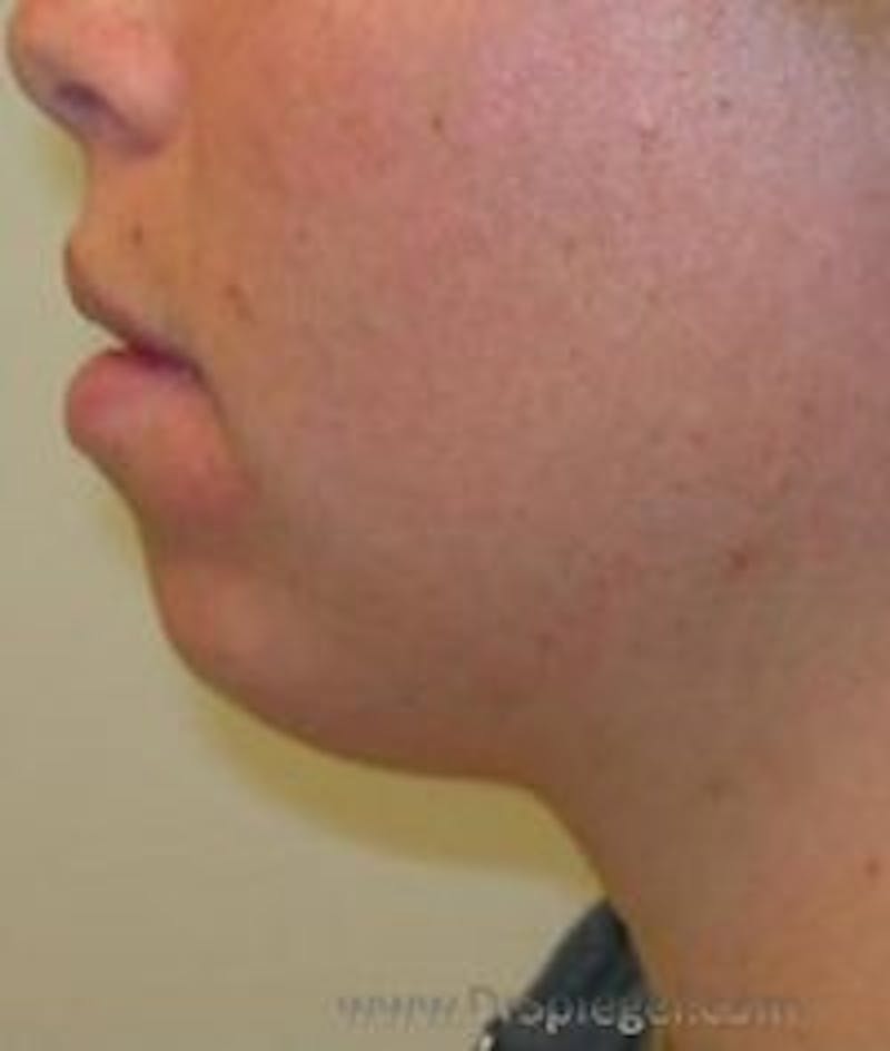 Chin Augmentation Before & After Gallery - Patient 157139922 - Image 1