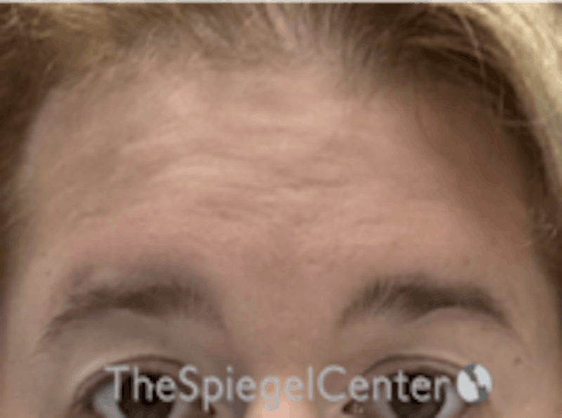 Forehead Contouring Before & After Gallery - Patient 157139927 - Image 1