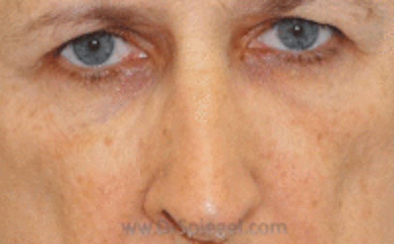 Blepharoplasty Before & After Gallery - Patient 157139925 - Image 1