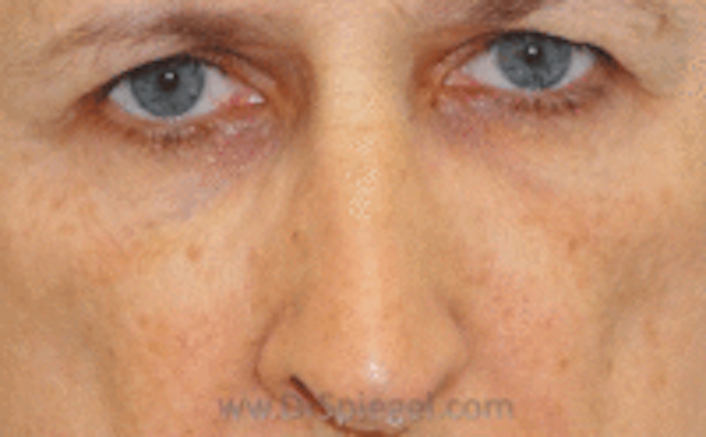 Blepharoplasty