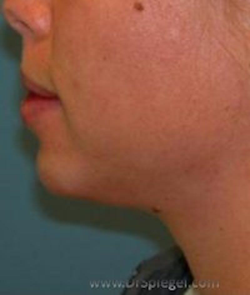 Chin Augmentation Before & After Gallery - Patient 157139922 - Image 2