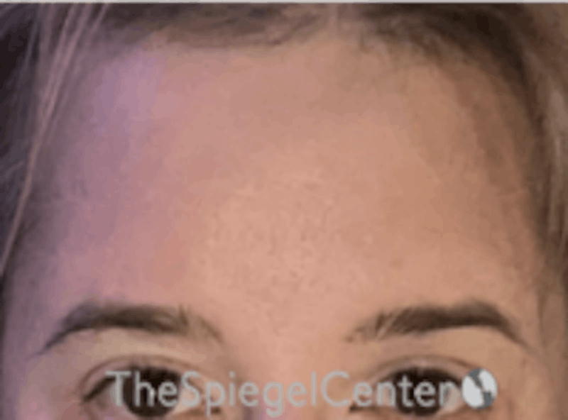 Forehead Contouring Before & After Gallery - Patient 157139927 - Image 2