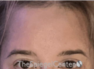Forehead Contouring Before & After Gallery - Patient 157139927 - Image 2