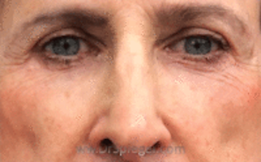 Blepharoplasty